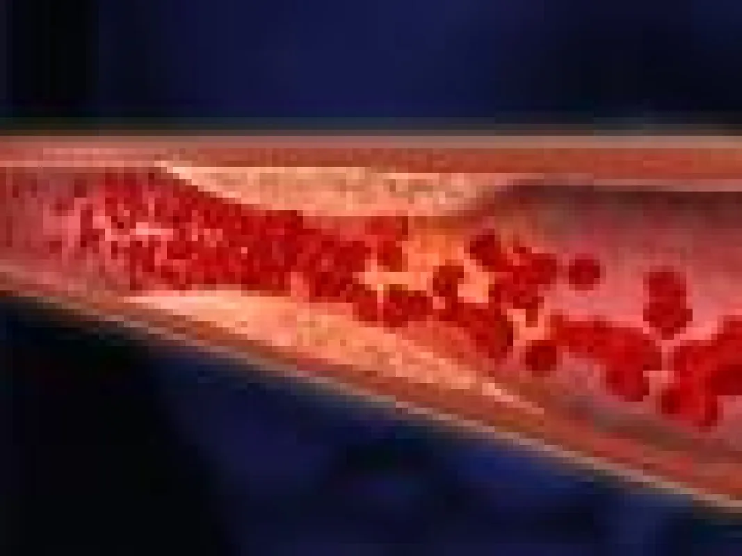 Arteriosklerose