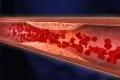 Bild: Arteriosklerose