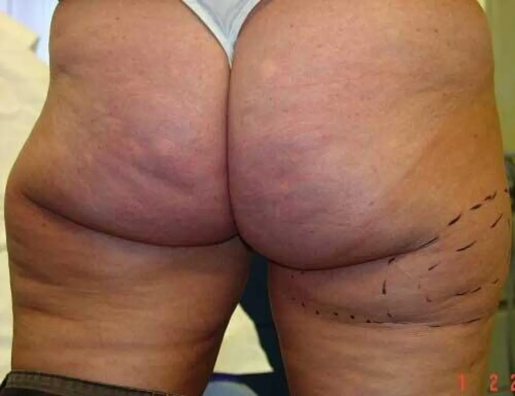 Liposuktion, ©medicalpicture