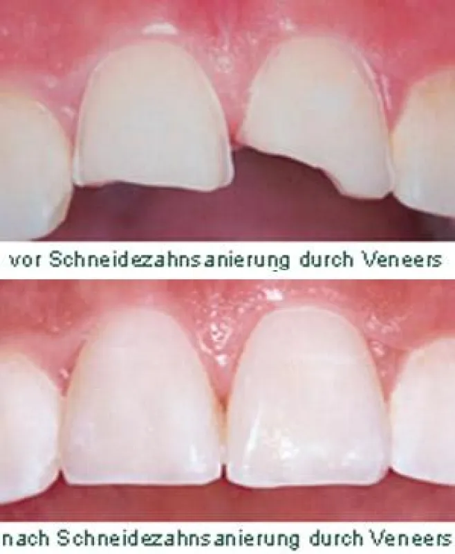 Veneers Behandlung