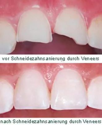 Bild: Natürliche Ästhetik durch Einsatz von Veneers