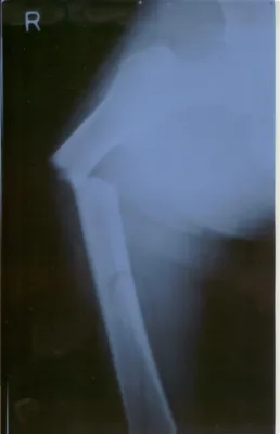 Bild: Es ist nicht immer Osteoporose