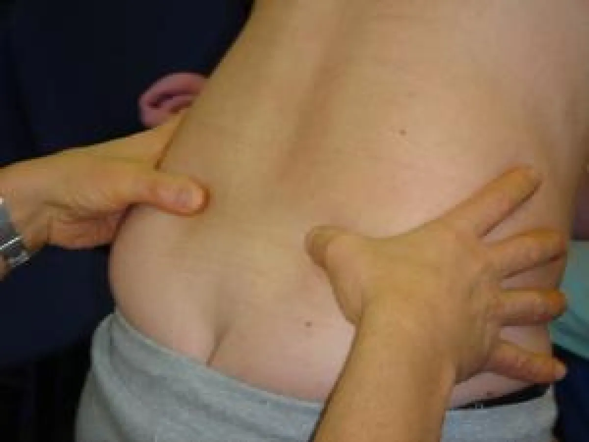 Diagnose Spina iliaca posterior superior (oberer Darmbeinstachel)