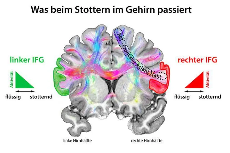 Bild: Stottern: Stoppsignale im Gehirn verhindern flüssiges Sprechen