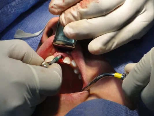 Bild: Welche verschiedenen Implantat-Arten gibt es und wo kommen sie zum Einsatz?