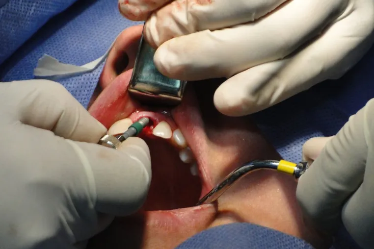 Bild: Welche verschiedenen Implantat-Arten gibt es und wo kommen sie zum Einsatz?