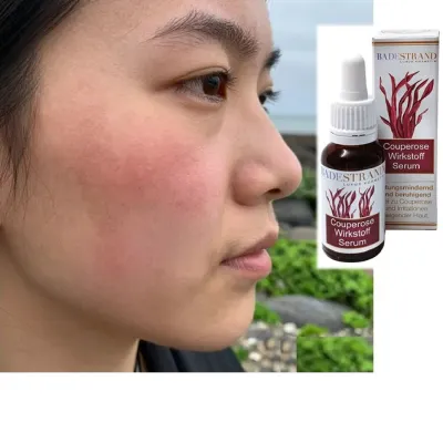 Bild: Couperose-Wirkstoff-Serum - Rötungsmindernd & hautverbessernd