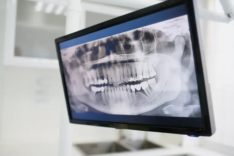 Bild: Präzise 3D-Bildgebung mit Hilfe der DVT - warum sinnvoll und wann nützlich?