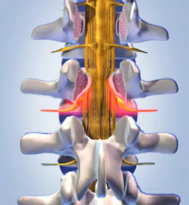 Bild: Mit zunehmendem Alter leiden viele an einem verengten Spinalkanal