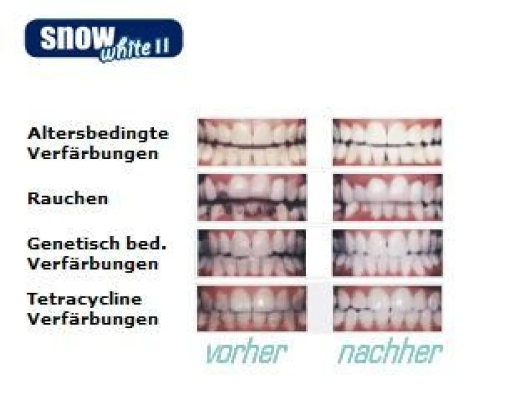 SNOW WHITE II Bleaching Ergebnisse www.snow-white.de