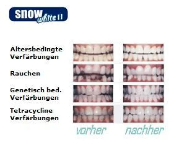 Bild: Bleaching ist nicht gleich Bleaching SNOW WHITE II  Bleaching mit Carbamide Peroxide hält was es verspricht