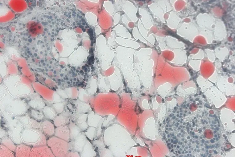 Fettleber produziert Eiweiße, die andere Organe schädigen können Bild: Fettleber produziert Eiweiße, die andere Organe schädigen können