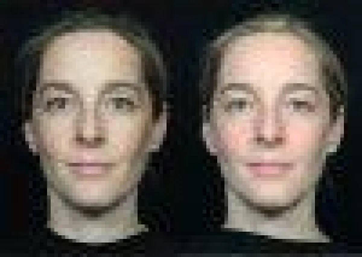 Vor dem Laserpeel und 10 Tage danach