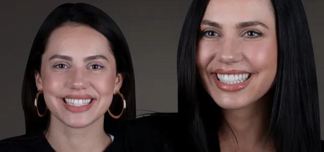 Bild: Veneers – Perfektion im Zehntelmillimeter