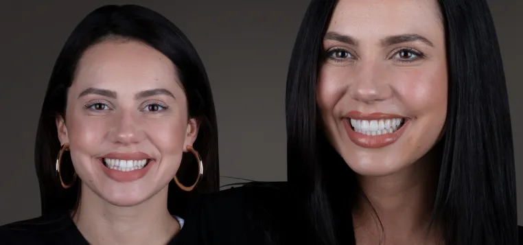 Bild: Veneers – Perfektion im Zehntelmillimeter