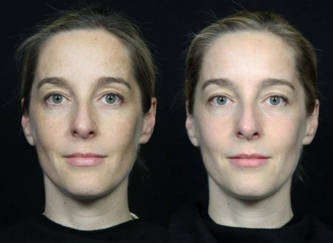 Ergebnis 1 Monat nach der Laserpeel-Behandlung