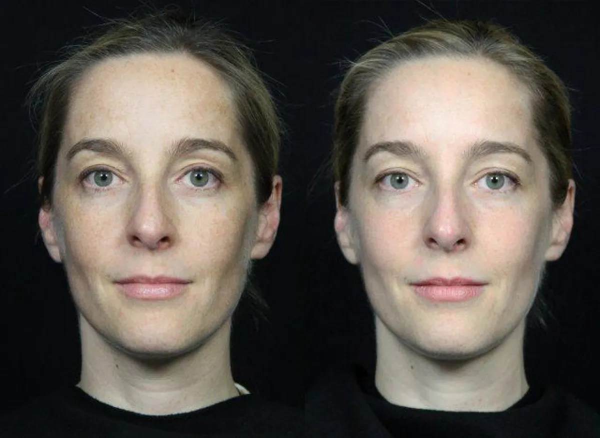 Ergebnis 1 Monat nach der Laserpeel-Behandlung