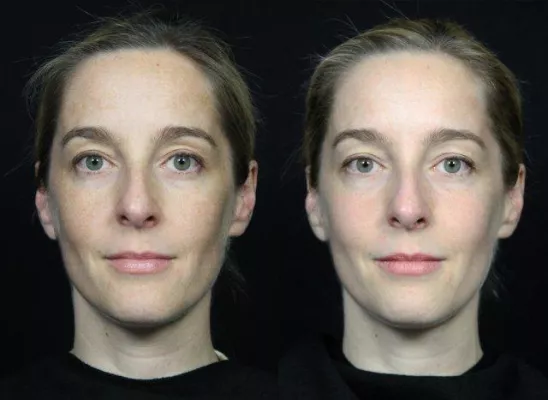 Bild: Laserpeel - Der sichere Weg zu makelloser Haut