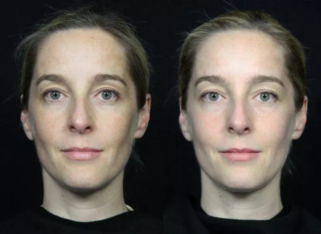 Bild: Laserpeel - Der sichere Weg zu makelloser Haut