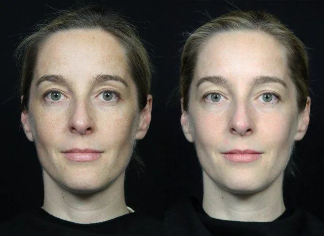 Bild: Laserpeel - Der sichere Weg zu makelloser Haut