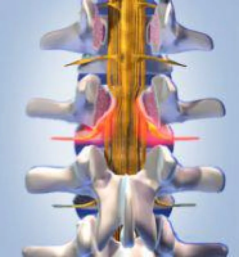minimalinvasive Bandscheiben Operation
