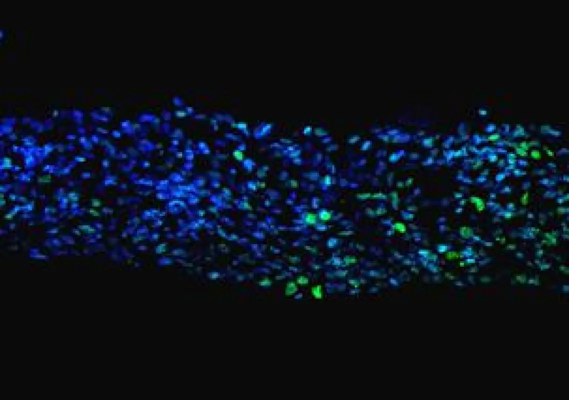 Speziell gefärbter Gewebeschnitt eines menschlichen Tumors einer Gewebekultur entnommen. // University of Leipzig, F. Merz