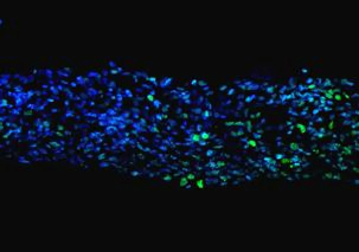 Speziell gefärbter Gewebeschnitt eines menschlichen Tumors einer Gewebekultur entnommen. // University of Leipzig, F. Merz