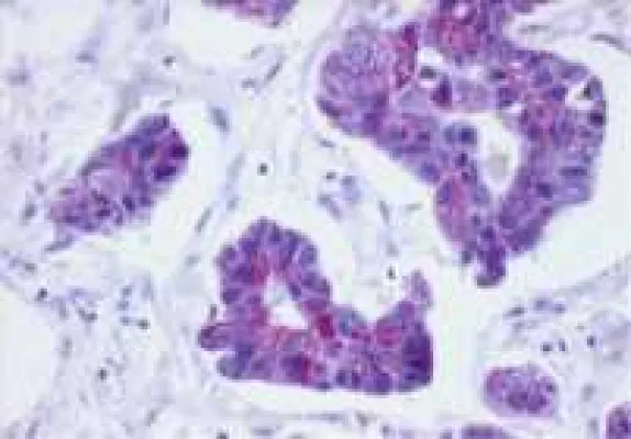 Entzündungen – Die Tür zum Tumor? Bild: Entzündungen – Die Tür zum Tumor?