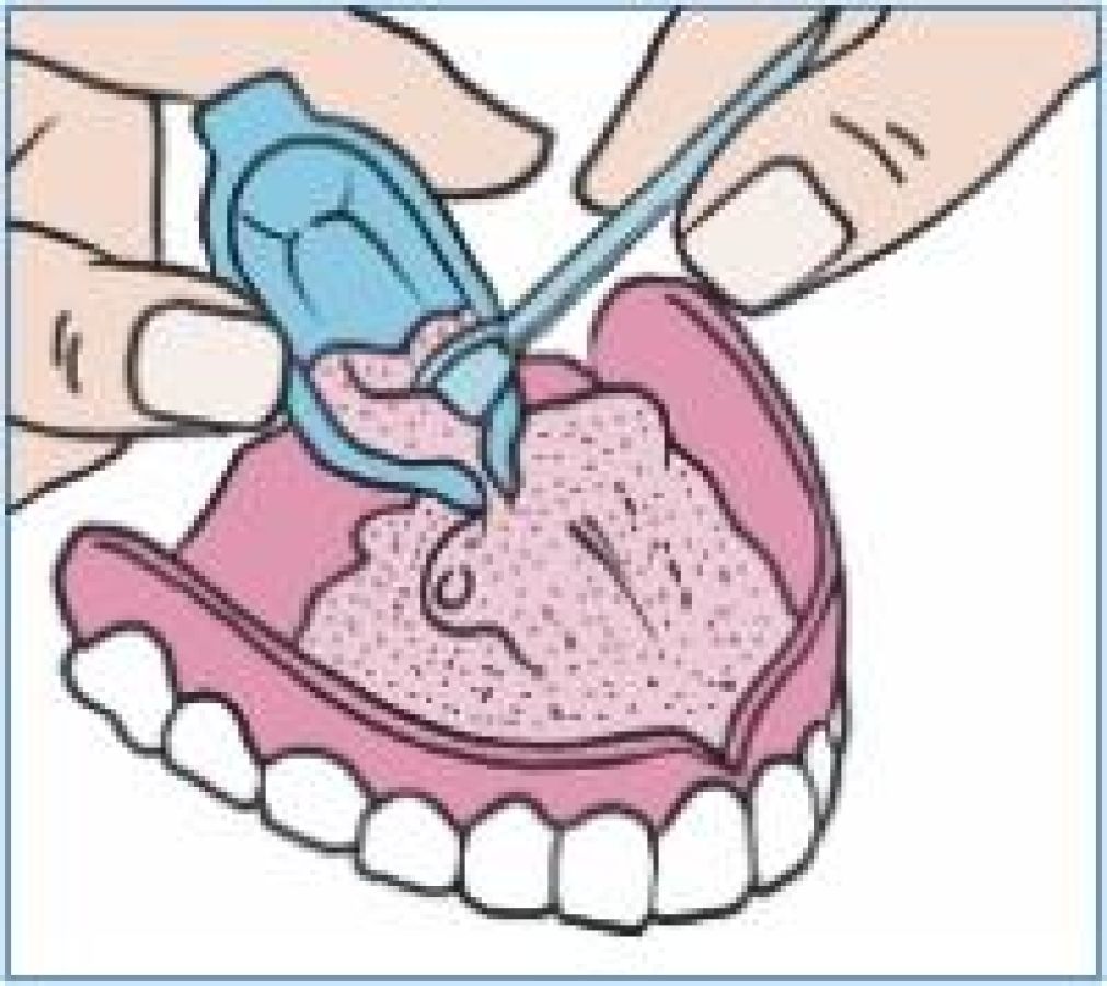 Wenn die Zahnprothese drückt, wackelt oder schmerzt openPR
