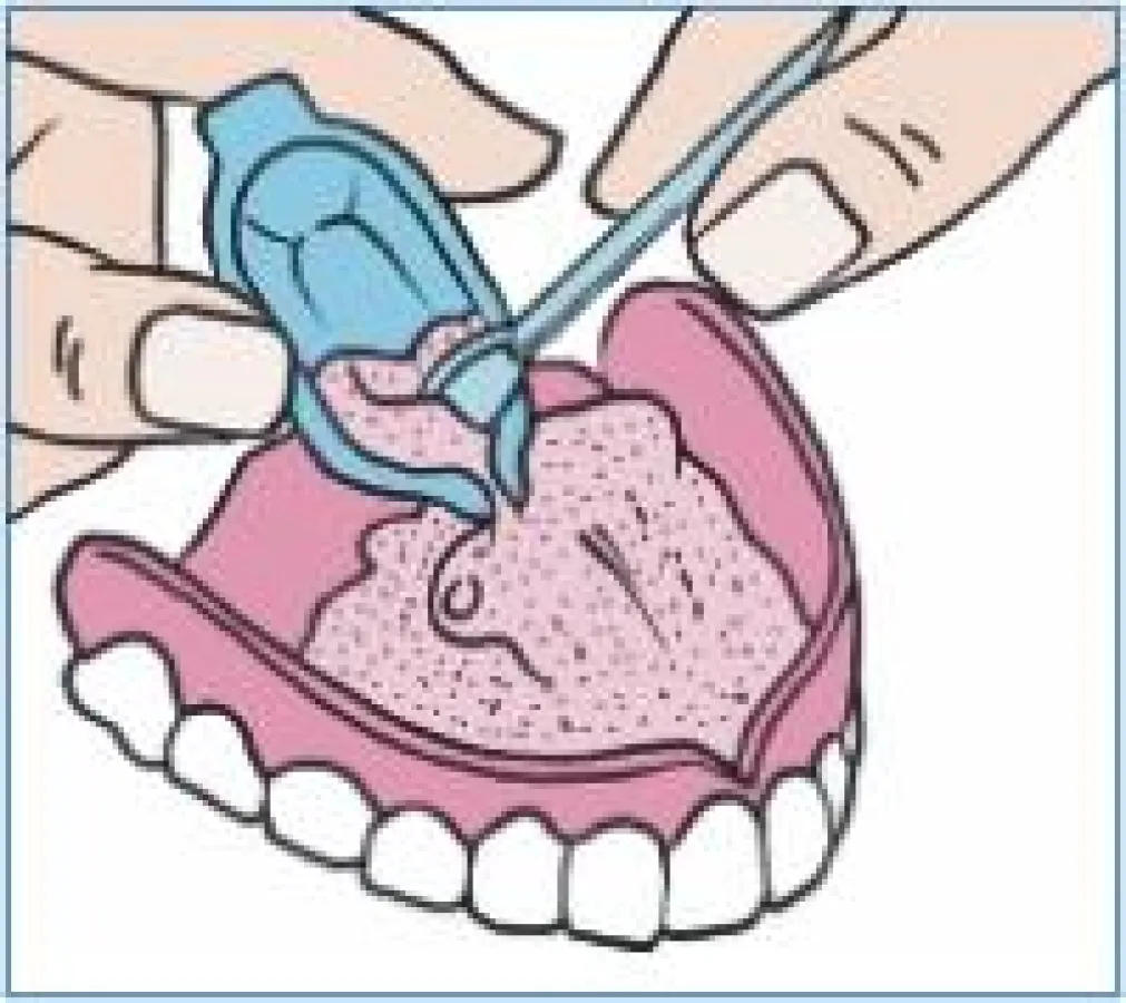 Eine druck- und schmerzfreie Passform entsteht