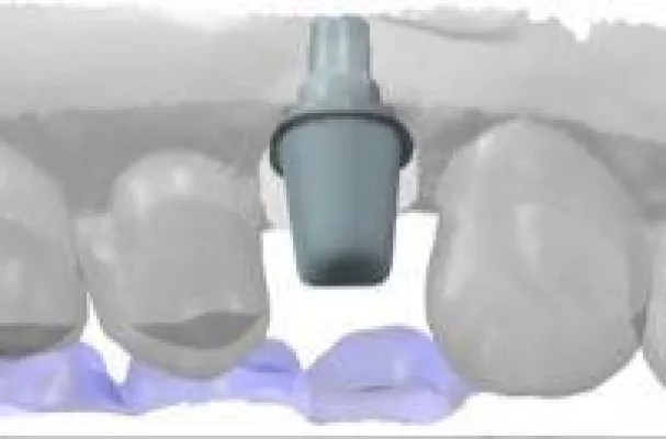 Bild: Keramik Implantate - für wen, wann, warum?