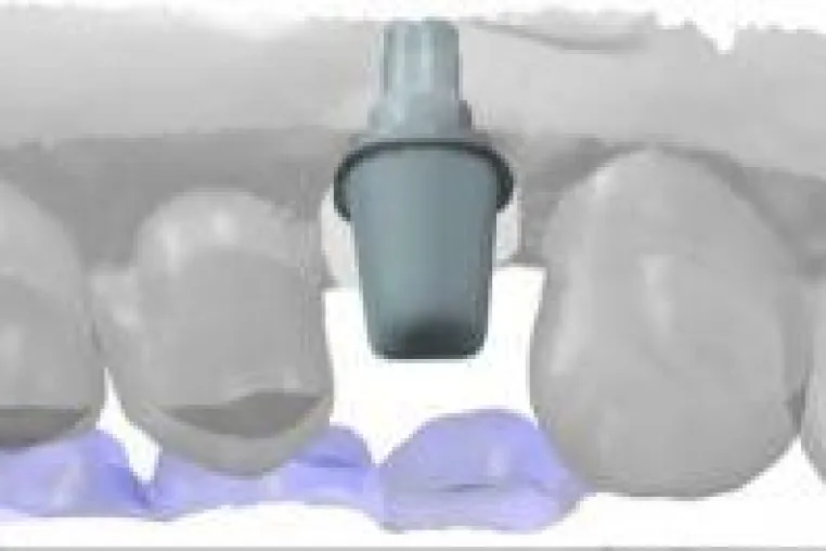 Bild: Keramik Implantate - für wen, wann, warum?