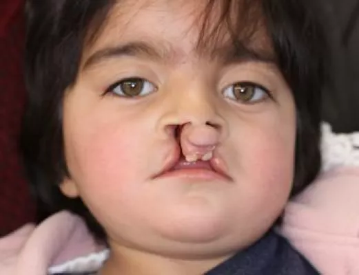 Stiftung finanziert OP im Klinikum Dortmund: Lippen-Kiefer-Gaumenspalte bei afghanischem Mädchen operiert Bild: Stiftung finanziert OP im Klinikum Dortmund: Lippen-Kiefer-Gaumenspalte bei afghanischem Mädchen operiert