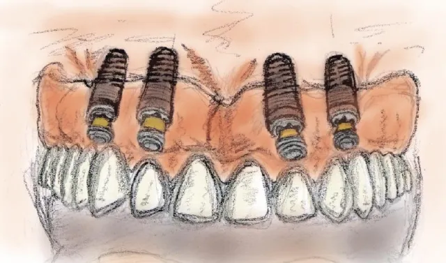 Mehr Lebensqualität für ältere zahnlose Patienten mit SKY Implantaten und Locator® Bild: Mehr Lebensqualität für ältere zahnlose Patienten mit SKY Implantaten und Locator®