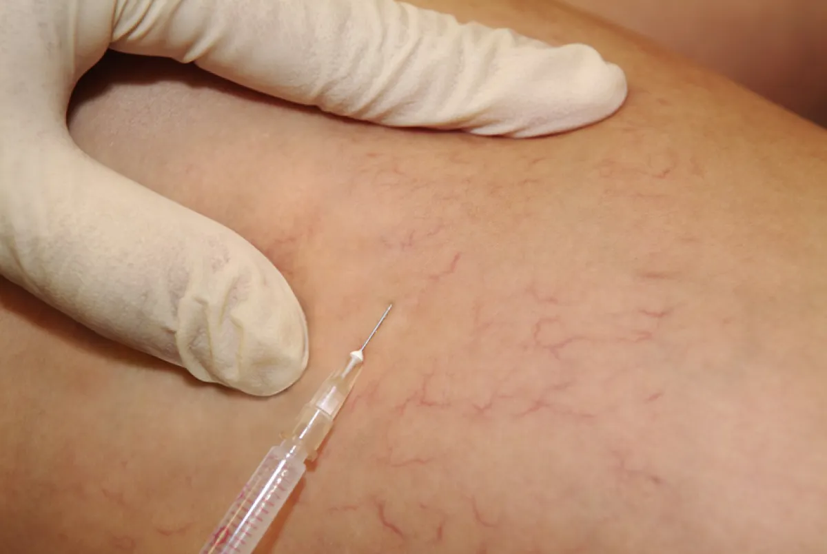 Besernreiser lassen sich durch die Mikro-Sklerotherapie einfach entfernen