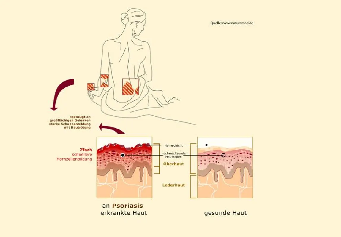 Psoriasis – Vergleich von gesunder und kranker Haut.  Quelle: www.naturamed.de