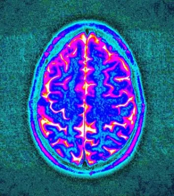 Genetische Ursachen der Migräne entdeckt Bild: Genetische Ursachen der Migräne entdeckt