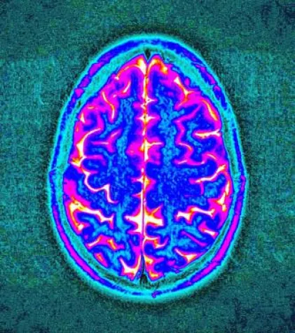 Bild: Genetische Ursachen der Migräne entdeckt