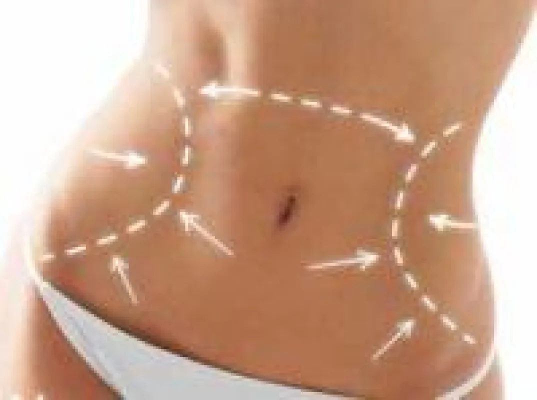 Vitalitas Bauchstraffung