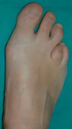Bild: Die Brachymetatarsie- Neue Behandlungsmöglichkeiten bei angeborenen Fußdeformitäten