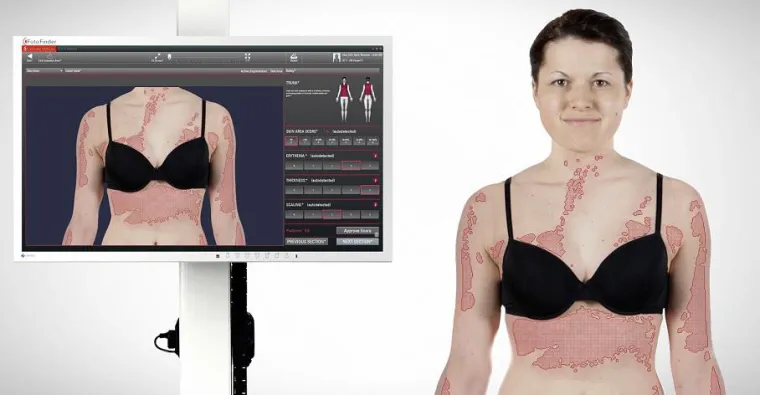 Bild: Psoriasis: Fotodokumentation hilft Patienten