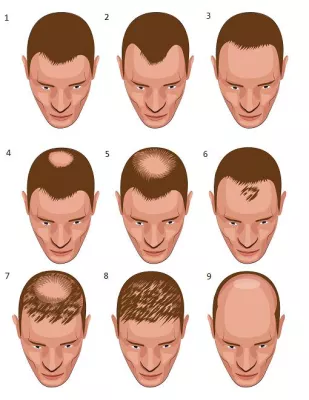 Bild: Die richtige Klinik für eine Haartransplantation finden