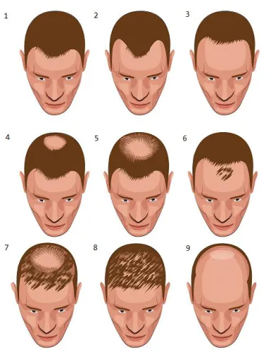 Bild: Die richtige Klinik für eine Haartransplantation finden