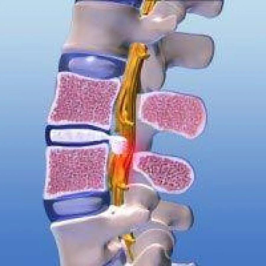Apex Spine Bandscheibenoperation