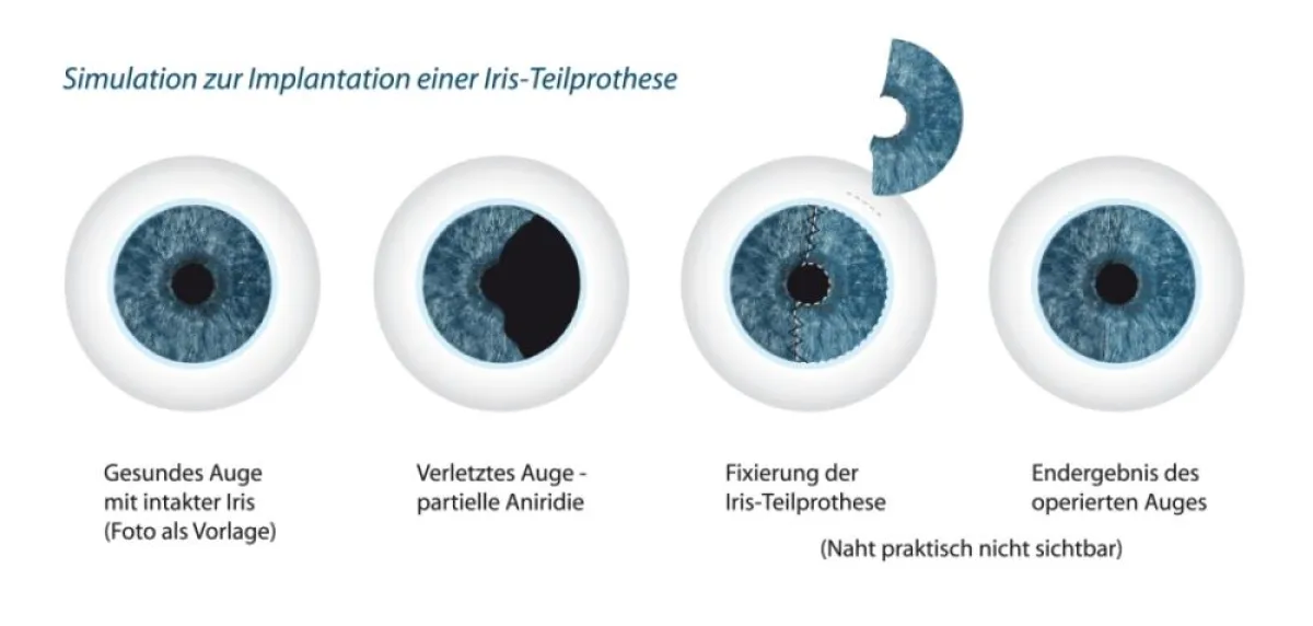 Simulation der Implantation der künstlichen Iris
