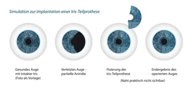 Bild: Gut (Aus-)Sehen trotz Irisdefekt - Neue künstliche Regenbogenhaut im Auge für großes Plus an Lebensqualität
