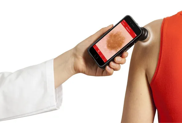 Bild: handyscope für iPhone 6: Mobile Hautkrebsdiagnostik mit dem Smartphone
