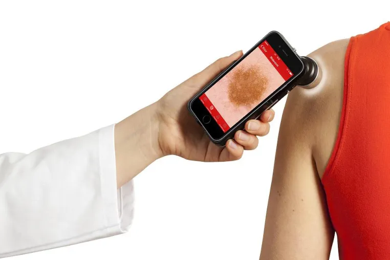handyscope für iPhone 6: Mobile Hautkrebsdiagnostik mit dem Smartphone Bild: handyscope für iPhone 6: Mobile Hautkrebsdiagnostik mit dem Smartphone