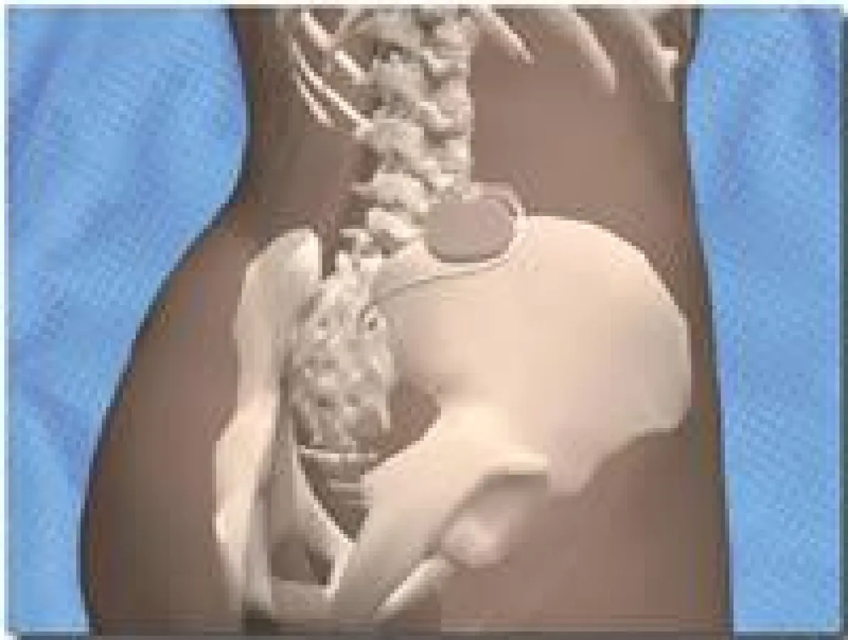 Implantierter Schrittmacher (Foto: medtronic mit freundlicher Genehmigung)