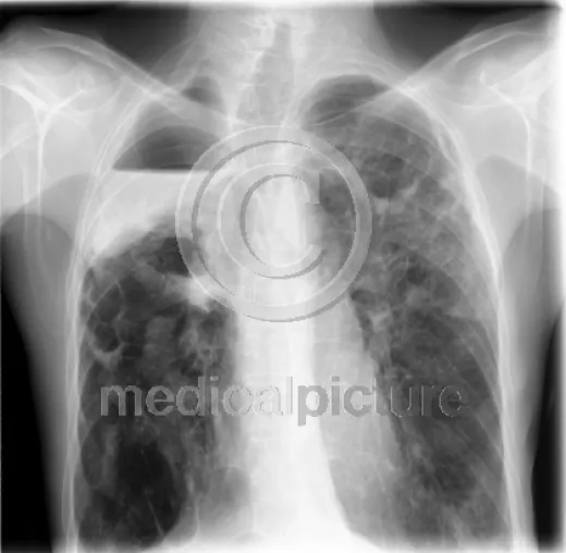 Bild: Tuberkulose - eine alte Seuche wird zur neuen Gefahr